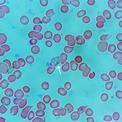 Sticker - Plasmodium vivax in thin film under microscopy, Malaria disease. P. vivax, Malaria parasite in red blood cells