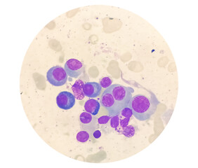 Poster - Microscopic view of bone marrow slide showing Multiple myeloma, a type of bone marrow cancer.