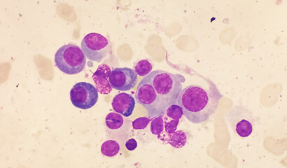 Sticker - Microscopic view of bone marrow slide showing Multiple myeloma, a type of bone marrow cancer.