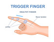 © 100% HAND-CRAFTED - Trigger finger concept. Medical infographics and educational materials. Biology and anatomy. Template and layout. Cartoon flat vector illustration isolated on white background