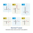 There are many morphologies of normal T waves, and some are tall, low, notched, and inverted T waves that can be confused with pathological T wave changes.