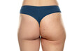 © vladimirfloyd - Comparison before and after woman's buttocks with stretch marks removal treatment on a white background
