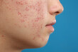 © New Africa - Teenage girl with acne problem on blue background, closeup