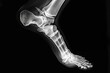 © Iftikhar alam - This x-ray captures a detailed view of a foot with a bone clearly visible, 3D X-ray interpretation of a human ankle and foot, AI Generated