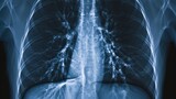 Fototapeta  - X-ray of a lung with pneumonia and pleural effusion.