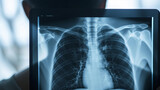 Fototapeta  - Tuberculosis infection in the lungs on chest x-ray