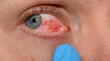 Problem z oczami, zbliżenie na otwarte zaczerwienione białko oko, popękane żyłki 