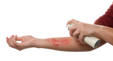 Wall Mural - Woman applying panthenol onto burned hand on white background, closeup