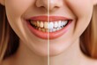 © LifeMedia - Image presenting a stark comparison between yellow stained teeth and post-whitening bright smile