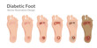 Diabetic foot different stages vector illustration.