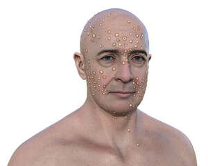 Poster - A man with rash from pox viruses, 3D illustration