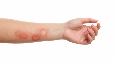 Canvas Print - Woman with burned hand on white background, closeup