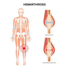 Poster - Hemarthrosis in the synovial joint