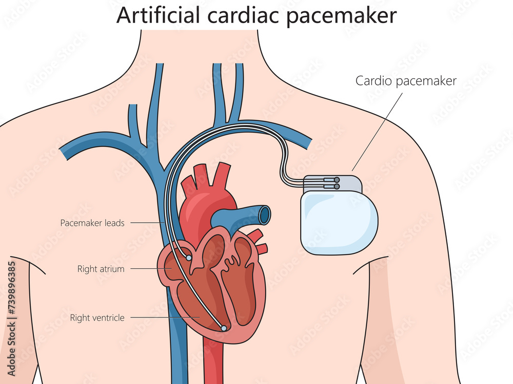 Artificial cardiac pacemaker medical device structure diagram hand ...