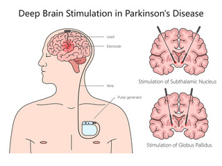 Wall Mural - Deep brain stimulation structure Parkinson disease diagram hand drawn schematic raster illustration. Medical science educational illustration