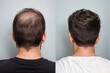 Man before and after hair loss treatments