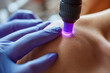 © ADDICTIVE STOCK - Laser therapy treatment on human skin close-up Generative AI image