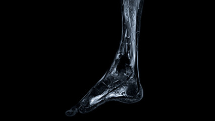 Poster - mri foot scan sagittal view t2 fat suppression technique for diagnostic tendon injury.