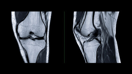 Poster - magnetic resonance imaging or mri of knee joint. this diagnostic technique is crucial for assessing 