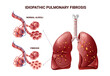 Pulmonary fibrosis alveoli structure. Vector illustration isolated on white background