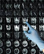 Hand in glove points Xray MRI examination magnetic resonance images showing real fracture knee