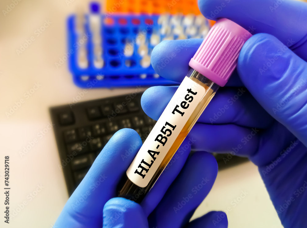 Blood sample for HLA B51 (human leukocyte antigen). to diagnose Behcet ...