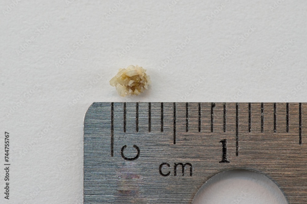 Measuring a kidney stone with a metal ruler Stock Photo | Adobe Stock