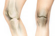 Female legs with x-ray of the patella with overlay effect on white, knee pain, knee pain, patella and pain
