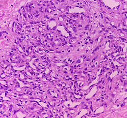 Poster - Swelling of middle finger (biopsy). Lobular Capillary hemangioma. A benign neoplasm of increased number of vessels with RBC lined by endothelial cells. Benign vascular proliferations.