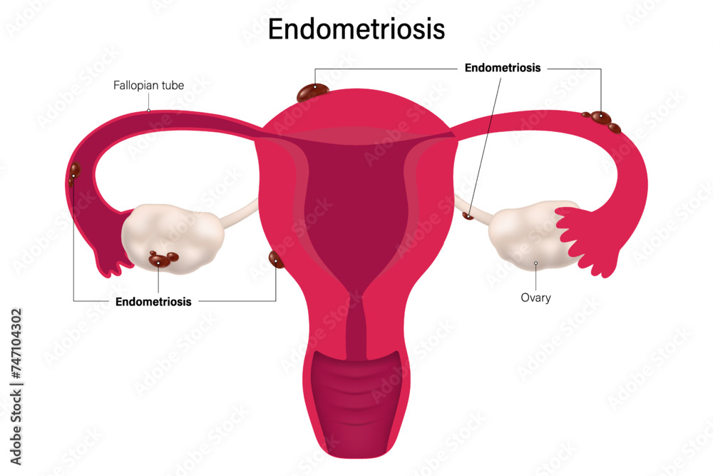 Endometriosis vector. A disease in which tissue similar to the lining