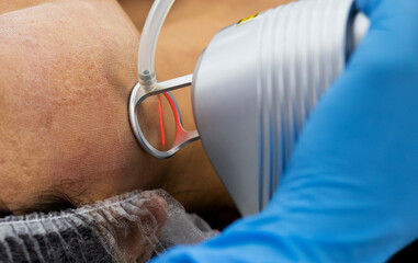 Face skin care. Asian woman getting facial laser treatment in clinic. 