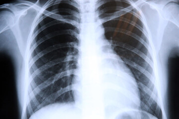 Canvas Print - Lungs Radiography. X-rays.