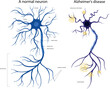 The structure of a sick and healthy neuron. Damaged neuron. Alzheimers disease. Brain disease dementia, memory disorders. A neuron in Alzheimer's disease