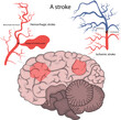 Vector illustration of a stroke. Hemorrhagic stroke and ischemic stroke of the brain.