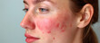 After successful rosacea treatment on a Caucasian woman's face, laser surgery removes redness and visible blood vessels.
