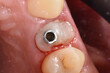 A close-up view inside person's mouth during dental examination 