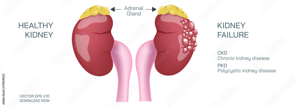 Chronic kidney failure, involves a gradual loss of kidney function. Your kidneys can't filter wastes and excess fluids from your blood. Vector illustration.