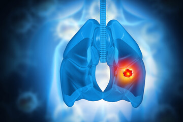 Wall Mural - Medical Illustration showing lung cancer or bronchial carcinoma. 3d illustration