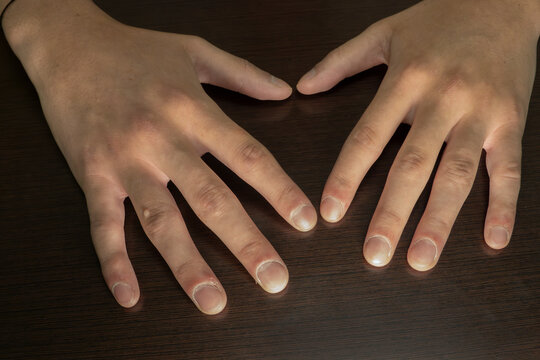 Young male with nail clubbing. Medical themes
