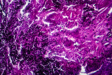 Canvas Print - Photomicrograph of lung tissue with silicosis pathology under a microscope, revealing silica particle accumulation in alveoli and fibrosis.