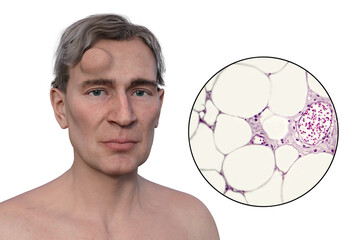 Wall Mural - Lipoma on a man's forehead, 3D illustration and micrograph