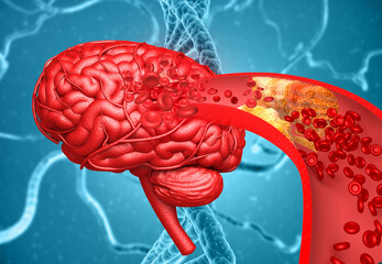 Wall Mural - Human brain stroke concept. Clogged vein in brain. 3d illustration.