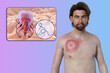 A man with erythema migrans, a characteristic rash of Lyme disease caused by Borrelia burgdorferi, 3D illustration