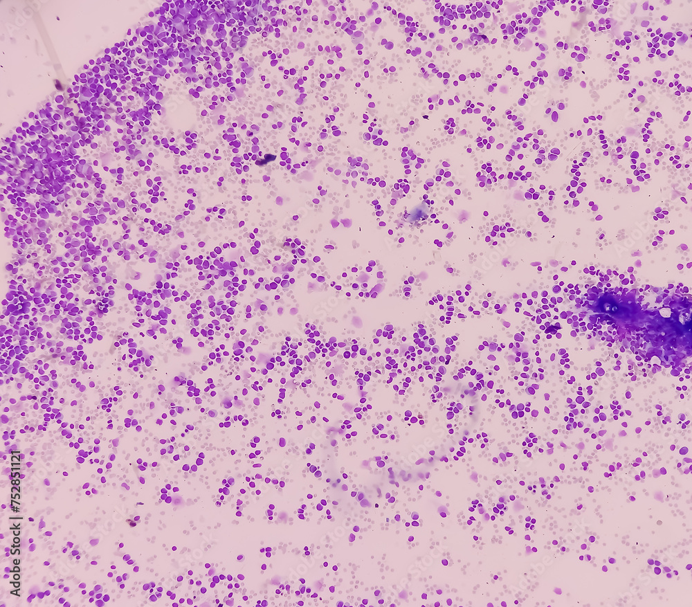 Blood cancer. Photomicrograph of Acute Myeloblastic Leukemia or AML, a ...