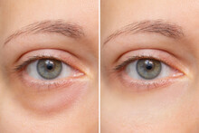 Close-up Of The Face Of A Young Woman With A Bag Under Her Eye Before And After Treatment. Swelling Of The Lower Eyelid. Removing Bruises And Dark Circles Using Cosmetics And Creams. Blepharoplasty