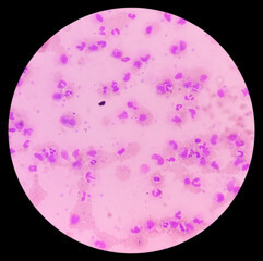 Canvas Print - Leukemia. Photomicrograph of hematological blood slide showing neutrophilic leukocytosis with monocytosis with occasional myelocytes seen. Chronic myelomonocytic leukemia. Thrombocytopenia.