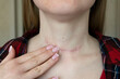 © Inna - scar after surgery on woman neck