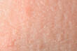 Texture of dry skin as background, macro view