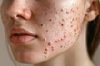 
Close-up image of acne scars fading over time, showcasing the progress of acne scar treatment.