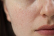 Macro view of woman with dry skin